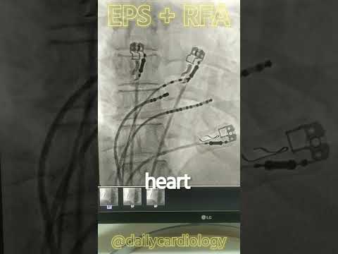 EPS RFA PROCEDURE | TREATMENT #shorts #cardiology